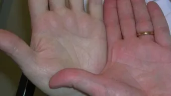 أنواع فقر الدم