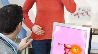 أنواع أكياس المبيض