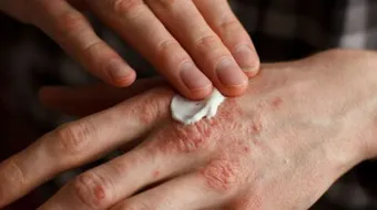 أنواع الصدفية