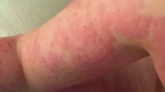 أنواع حساسية الجلد