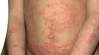 أنواع الأمراض الجلدية