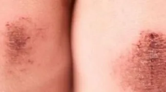 أنواع الجروح