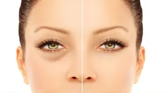 علاج انتفاخ تحت العين