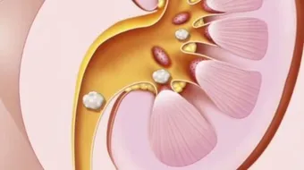 علاج حصوة الحالب - فيديو