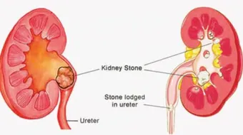 علاج حصى الحالب
