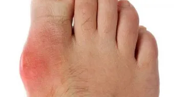 حمض اليوريك في الدم