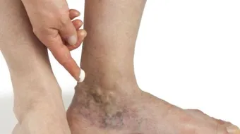 علاج دوالي الساقين