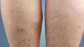 طرق علاج دوالي الساقين