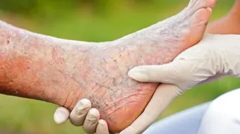 طرق علاج الدوالي