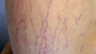 ظهور عروق في الجسم