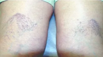 الليزر الوريدي و التردد الحراري في علاج دوالي الساقين