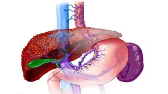 مرض التهاب الكبد الفيروسي وأعراضه