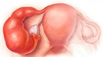 كيس مائي على المبيض