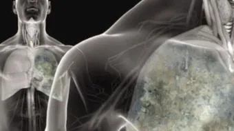 الماء على الرئة