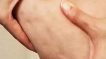 طرق التخلص من السيلوليت في الجسم