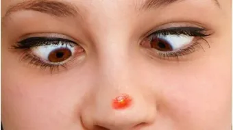 طرق للتخلص من حبوب الوجه