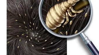 طرق للتخلص من القمل