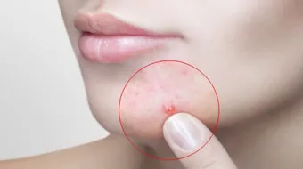 طرق التخلص من الحبوب في الوجه