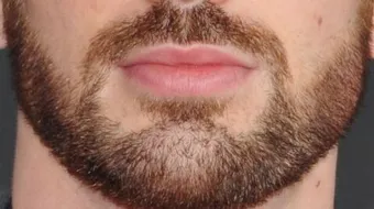 طرق زيادة شعر الذقن