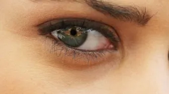 طرق إزالة الهالات السوداء تحت العين