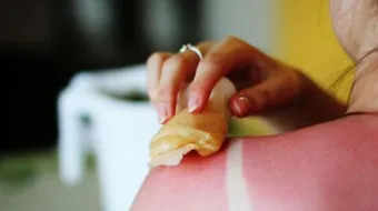 طرق لإزالة حروق الشمس