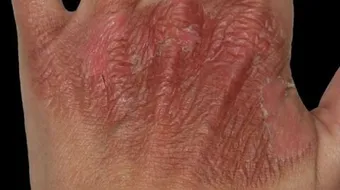 طرق لإزالة آثار الحروق من الجسم