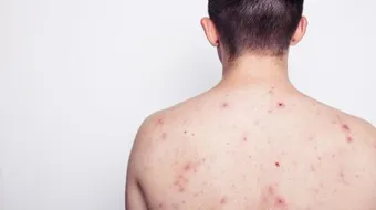 طرق لإزالة آثار الحبوب من الظهر