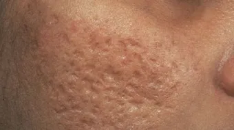 طرق لإزالة آثار الحبوب في الوجه