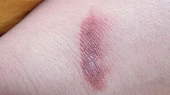 طرق لإزالة آثار الجروح من الجسم