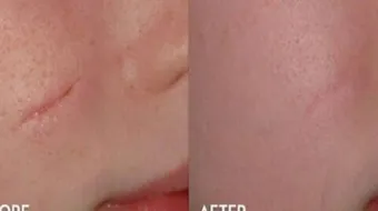 طرق لإزالة آثار الجروح