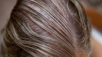 طرق علاج الشعر الخفيف