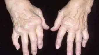 ما هي أمراض المناعة الذاتية