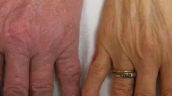 ما هي ترسبات الدم