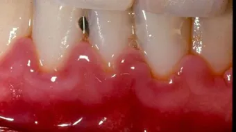 ما هي أمراض اللثة