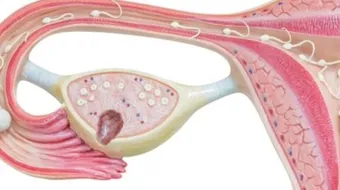 ما هي أسباب وجود كيس على المبيض