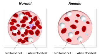 ما هي أسباب فقر الدم