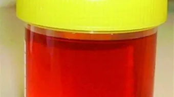 ما أسباب نزول الدم مع البول