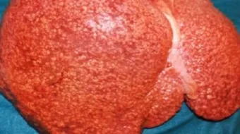 ما أسباب تشمع الكبد