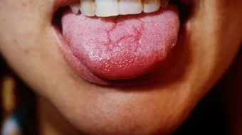 ما أسباب تشقق اللسان