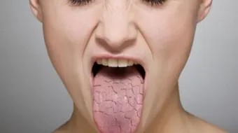 ما أسباب جفاف اللسان