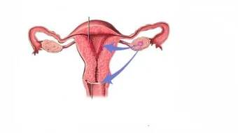 ما هي أسباب سمك بطانة الرحم