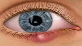 ما هي أسباب حساسية العين