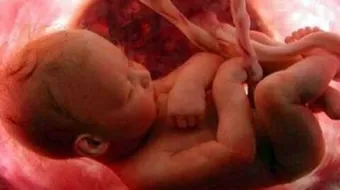 ما هي أسباب تشوه الجنين