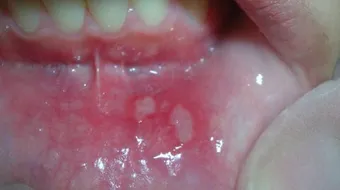 ما أسباب الفطريات في الفم