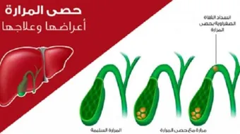 ما أسباب تكون حصوة المرارة