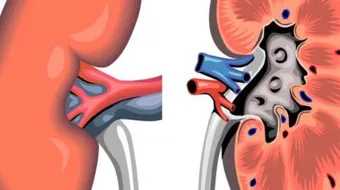 ما هي أسباب الفشل الكلوي