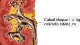 ما هي أسباب تكون الحصى في الكلى