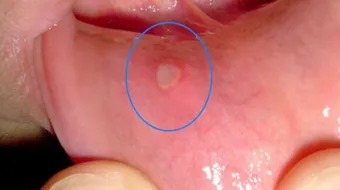 ما أسباب تقرحات الفم