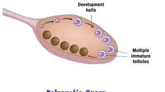 ما هي أسباب التكيس على المبايض