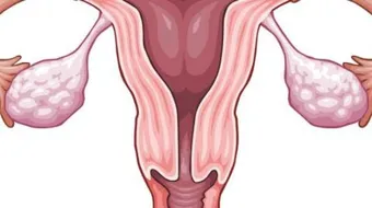 ما هي أسباب تكيس المبايض